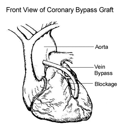 Coronary Artery Bypass Graft (Vein)