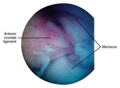 Knee arthroscopy