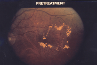 Macular Edema (Diabetic Retinopathy)