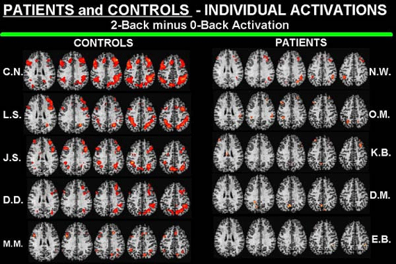 Schizophrenia PET Scans