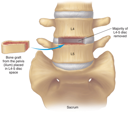 Vertebral fusion